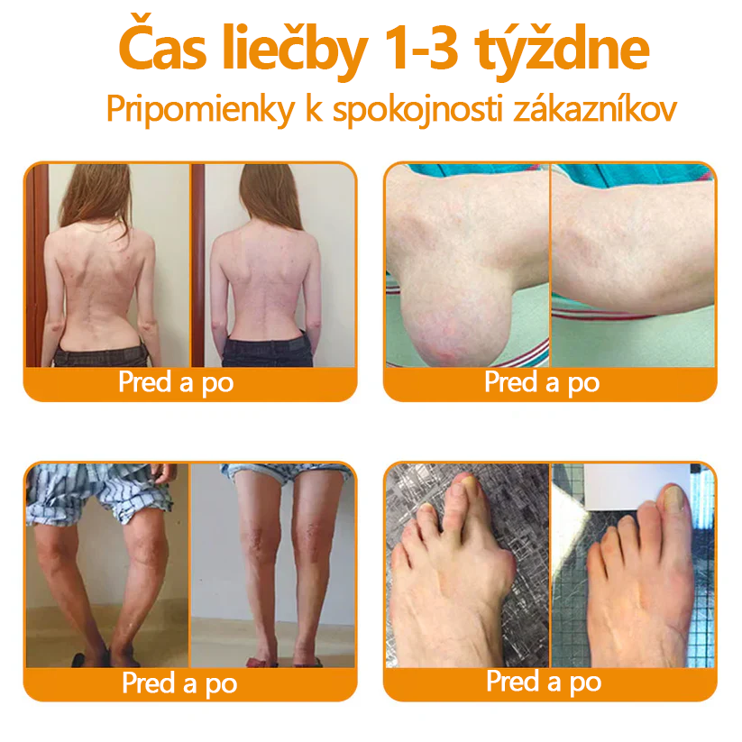 Ropceer™ hojivý krém na bolesť kostí s botulotoxínom a včelím jedom