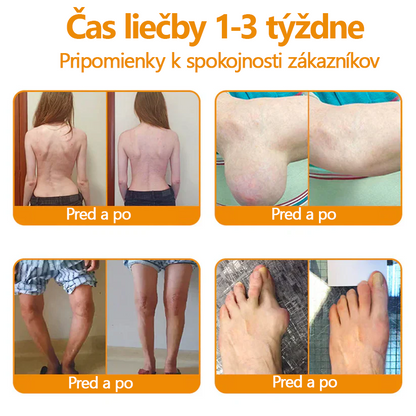 Ropceer™ hojivý krém na bolesť kostí s botulotoxínom a včelím jedom