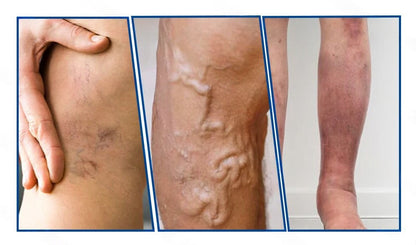 🇸🇰 Healrize® VeinTarget mikrojihlová náplasť 🏆 Okamžitá úľava, dlhodobé výsledky🎀🎀🎀