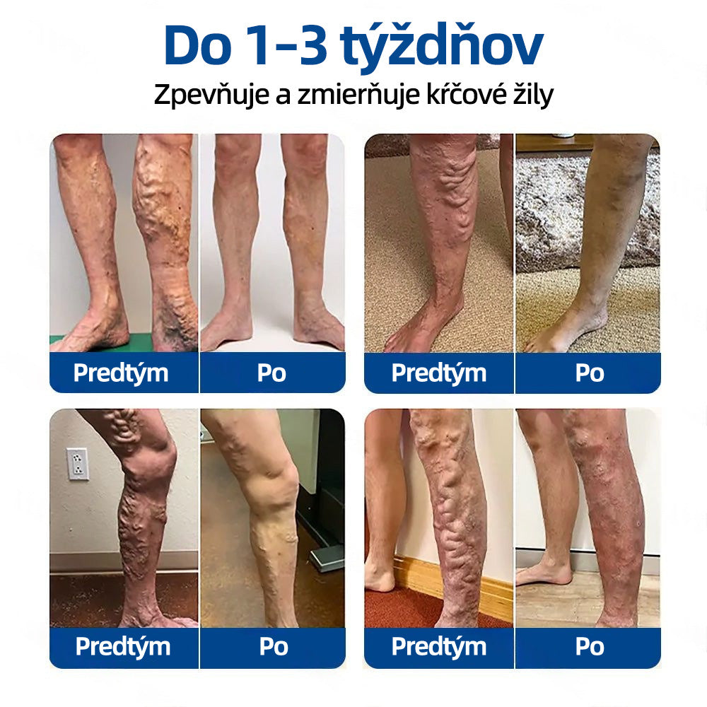 🇸🇰 Healrize® VeinTarget mikrojihlová náplasť 🏆 Okamžitá úľava, dlhodobé výsledky🎀🎀🎀