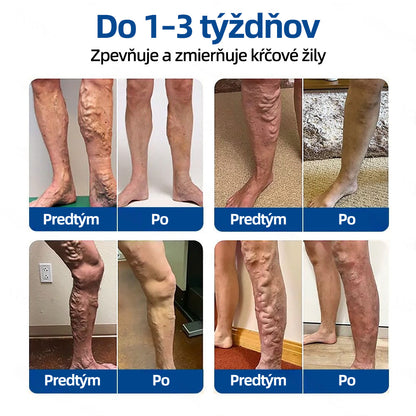 🇸🇰 Healrize® VeinTarget mikrojihlová náplasť 🏆 Okamžitá úľava, dlhodobé výsledky🎀🎀🎀