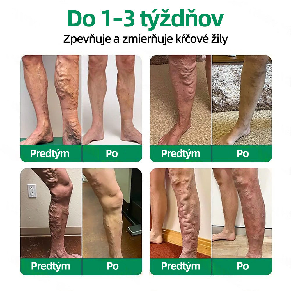 🇸🇰 Healrize® VeinTarget mikrojihlová náplasť 🏆 Okamžitá úľava, dlhodobé výsledky🪇🪇🪇