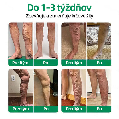 🇸🇰 Healrize® VeinTarget mikrojihlová náplasť 🏆 Okamžitá úľava, dlhodobé výsledky🪇🪇🪇