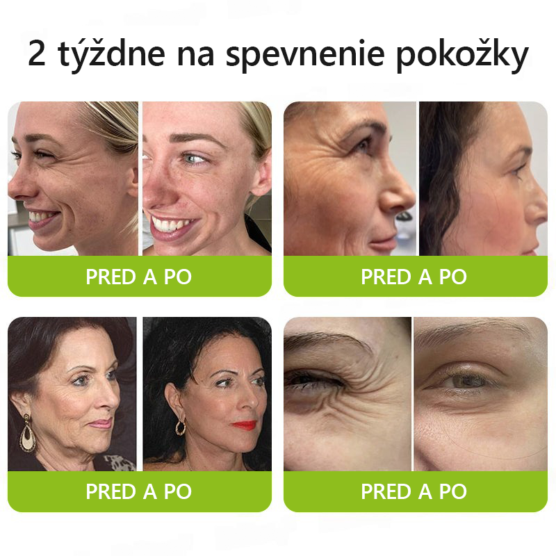 [🔥Last Day 70% OFF] Toclvo® Botox a vitamín A retinolová injekcia - Eraser for Deep Wrinkles, Sagging Jowls & Puffy Eyes
