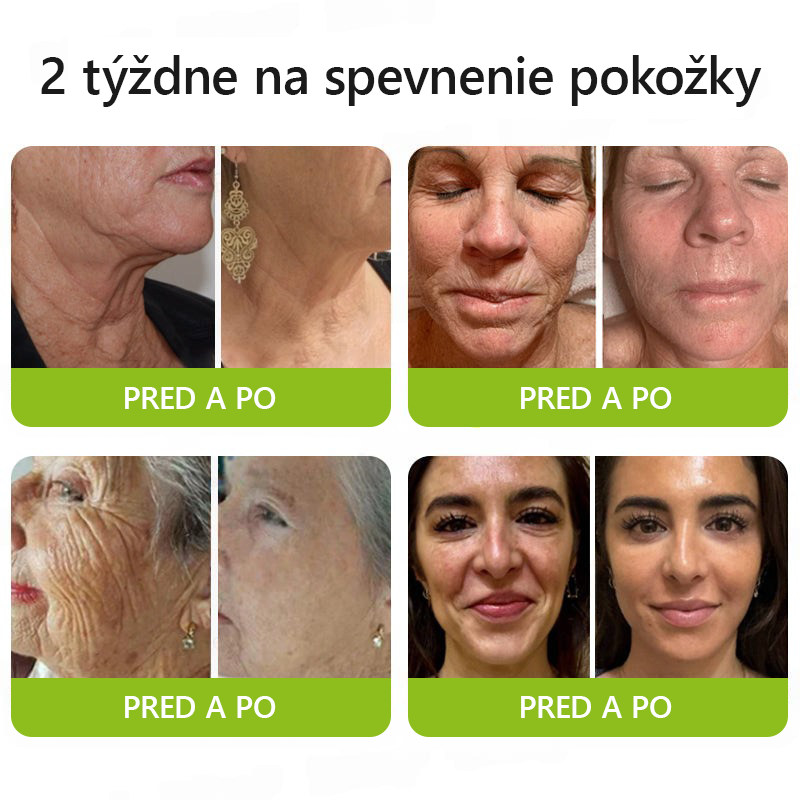 [🔥Last Day 70% OFF] Toclvo® Botox a vitamín A retinolová injekcia - Eraser for Deep Wrinkles, Sagging Jowls & Puffy Eyes